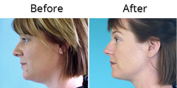 VASER LIPO Before And After Womans Chin - Medical Face & Body Aesthetics